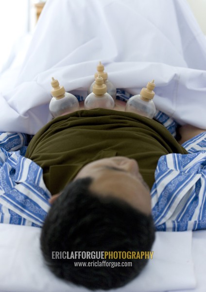 North Korean man having traditional cupping medicine in hopsital, Pyongan Province, Pyongyang, North Korea